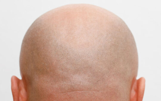 BALD Token Deployer Rug Pulls a Day After Launching on Base